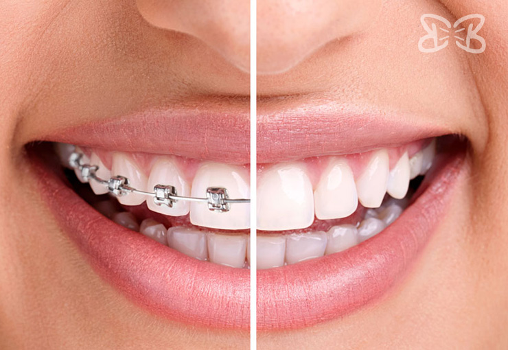 Brackets Convencionales en Dientes en Puebla