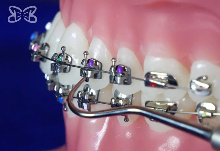 Brackets Autoligado en Puebla