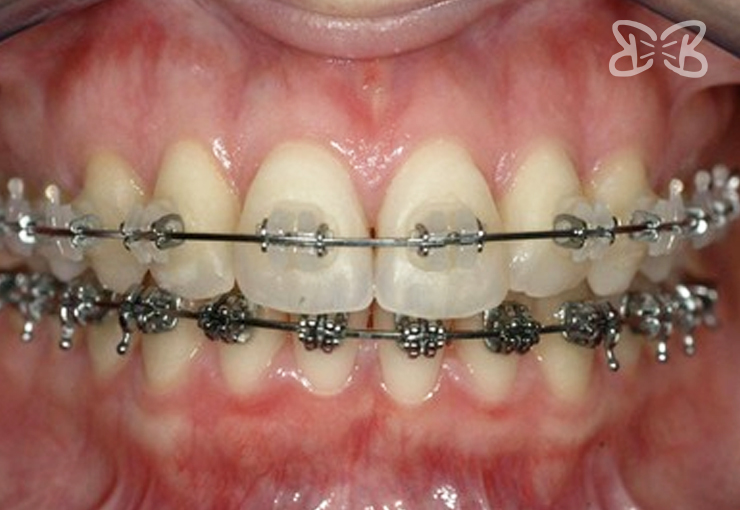 Brackets Baja Fricción en Puebla