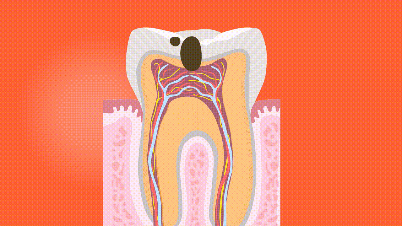 Tratamientos de Endodoncia en Puebla