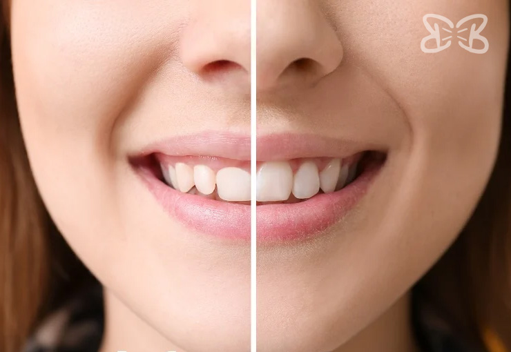 Gingivectomía en Puebla