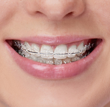 Brackets Autoligado