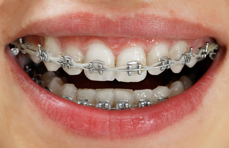 Aplicación de Brackets Estéticos Autoligado Baja Fricción en Puebla