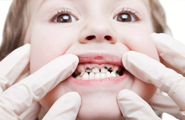 Tratamientos de Odontopediatria en Puebla