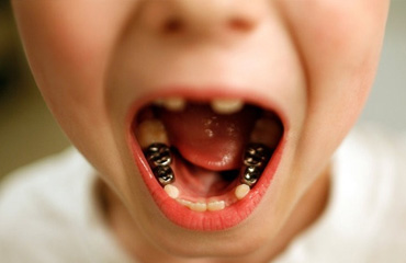 Tratamientos de Odontopediatria en Puebla