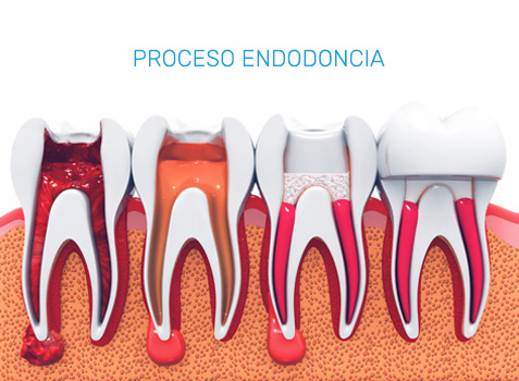 Tratamientos de Endodoncia en Puebla