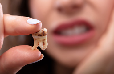 Tratamientos de Periodoncia en Puebla