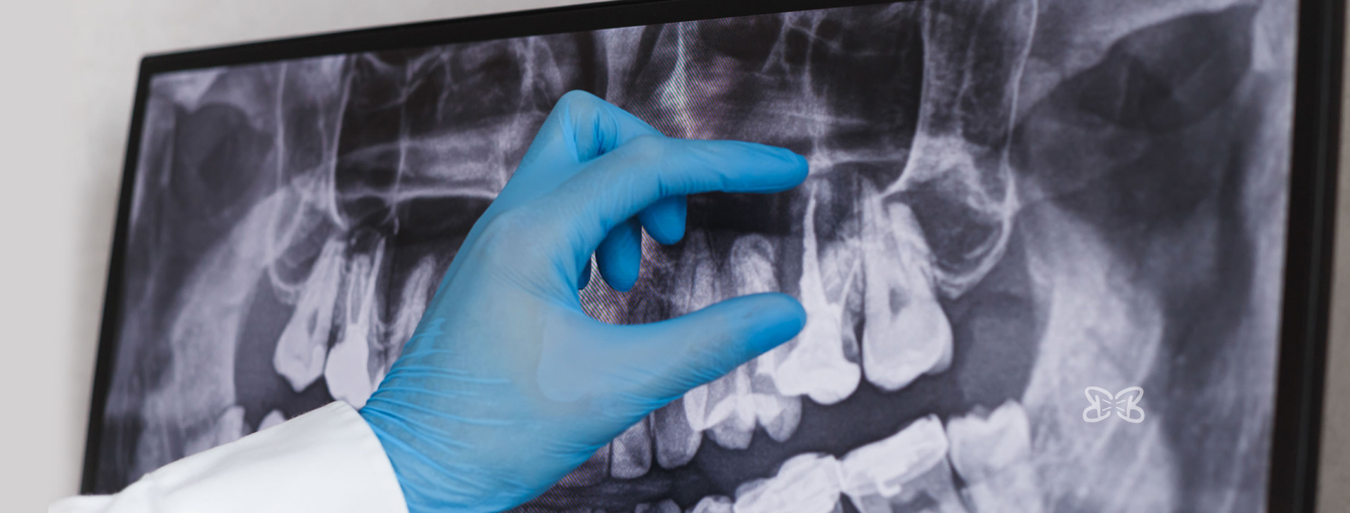 Tratamientos de Endodoncia en Puebla