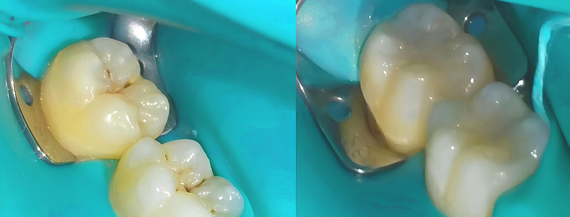 Servicios de Prevención Dental en Puebla
